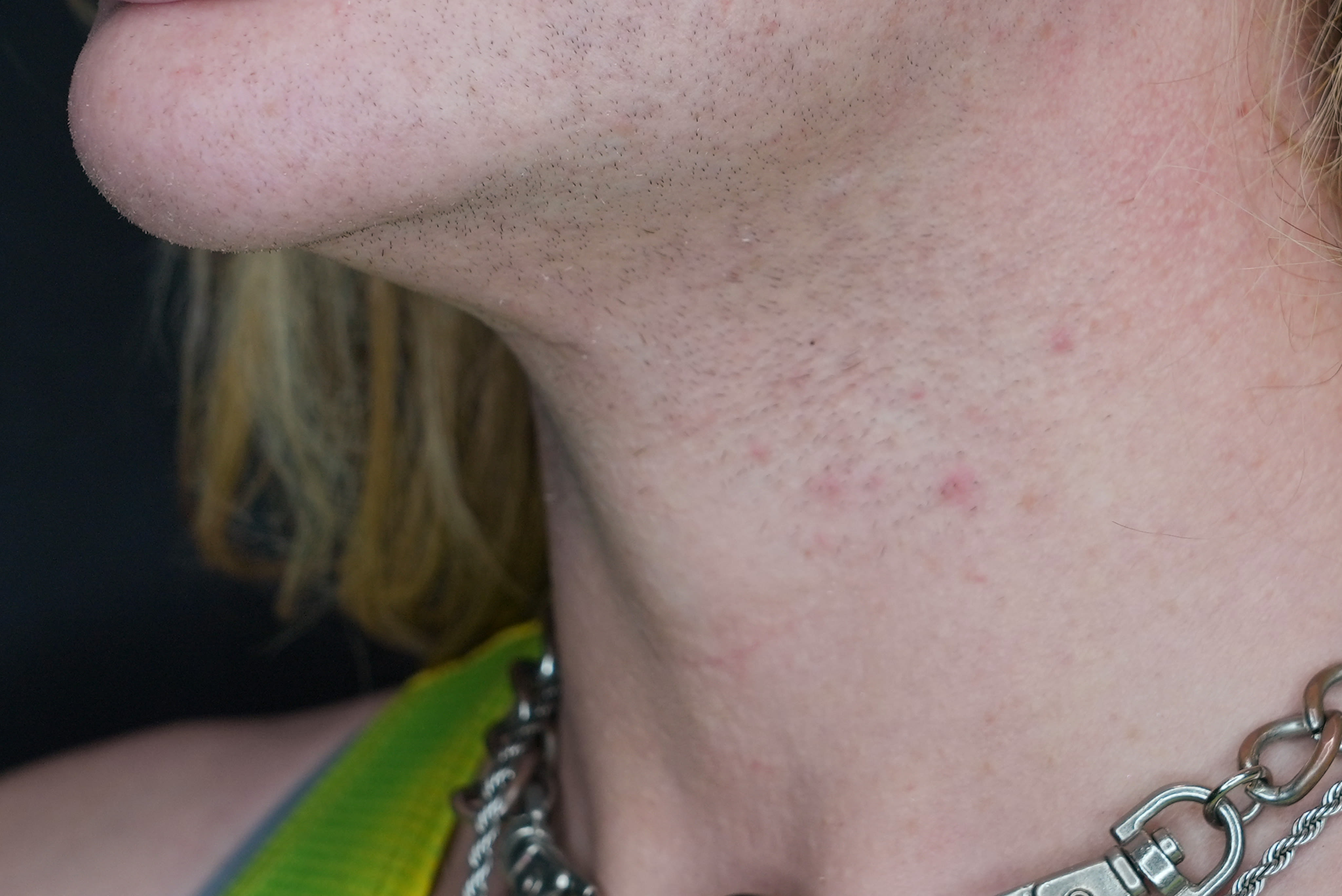 Laser hair removal chin before treatment